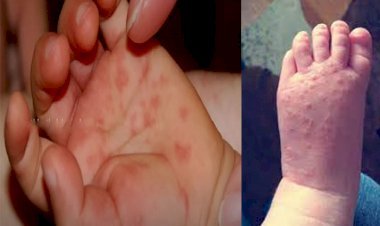 केरल में कोरोना के बीच तेजी से फैल रहा नया ‘टोमैटो फीवर वायरस’, सीमावर्ती इलाकों में रेडअलर्ट