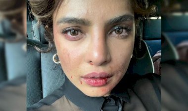 तो क्या प्रियंका चोपड़ा शूटिंग के दौरान हो गई जख्मी? फोटो देख फैंस को हुई चिंता