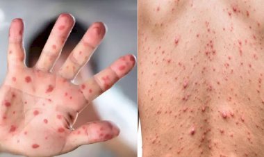 ...तो क्या यौन संबंधों से फैलता है ‘मंकीपॉक्स’! सामने आया चौंकाने वाला नया शोध 