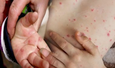 ‘टोमैटो फ्लू’ का आतंक! हरियाणा, तमिलनाडु और ओडिशा तक पहुंचा संक्रमण, ऐसे करें बचाव